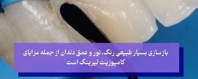 کامپوزیت لیرینگ؛ تکنیکی نوین برای لبخندی طبیعی‌تر