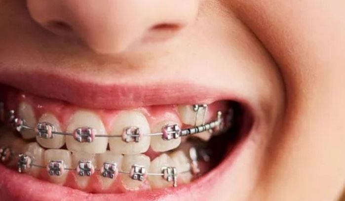 ارتودنسی فک پایین؛ بررسی کامل مزایا، معایب، شرایط انجام و هزینه‌ها