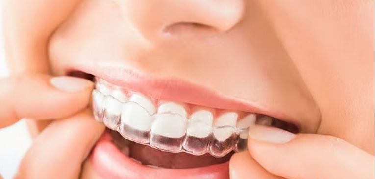 اصلاح دندان نیش بدون ارتودنسی؛ روش‌های مؤثر، مزایا، محدودیت‌ها و بهترین انتخاب‌ها